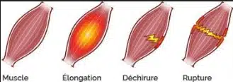 Schéma des différents stades de déchirure musculaire - du claquage à la rupture
