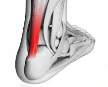 Tendinite du tendon d'Achille avec inflammation en rouge - blessure courante chez les coureurs