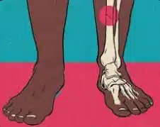 Anatomie du pied avec fracture de stress métatarsienne - blessure coureur longue distance